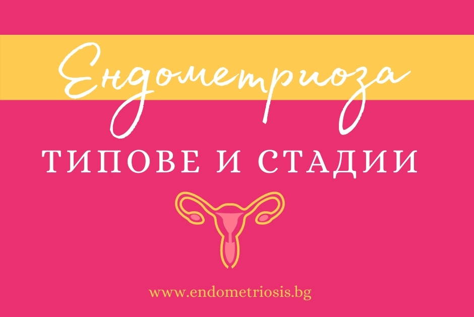 Ендометриоза – типове и стадии